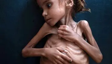 مرگ دختر یمنی که تصویرش جهان را تکان داد +عکس