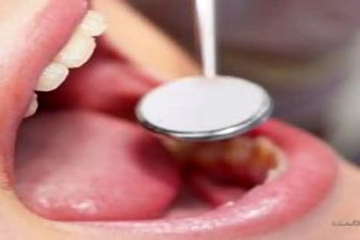 مهمترین علامت سرطان دهان چیست؟