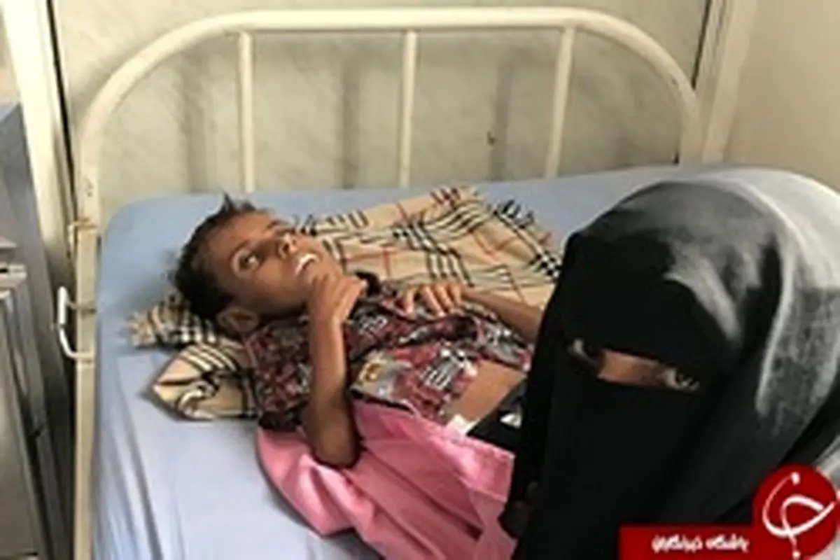 مرگ یک کودک یمنی بر اثر سوء‌تغذیه +عکس