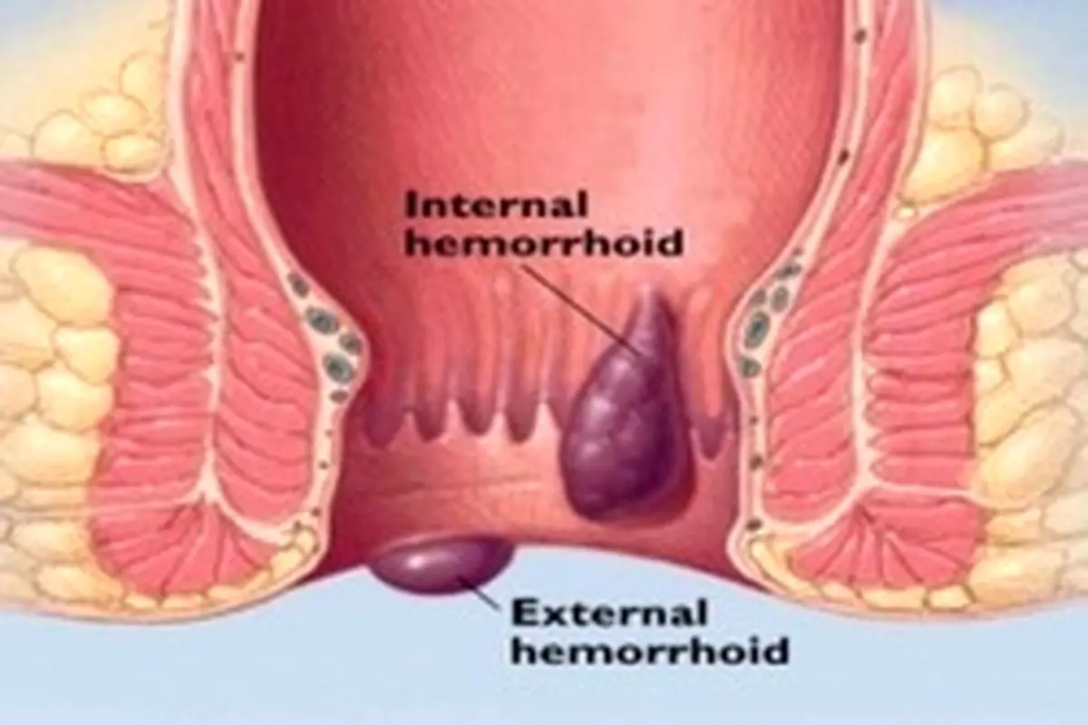 چرا به بیماری بواسیر دچار می‌شویم؟