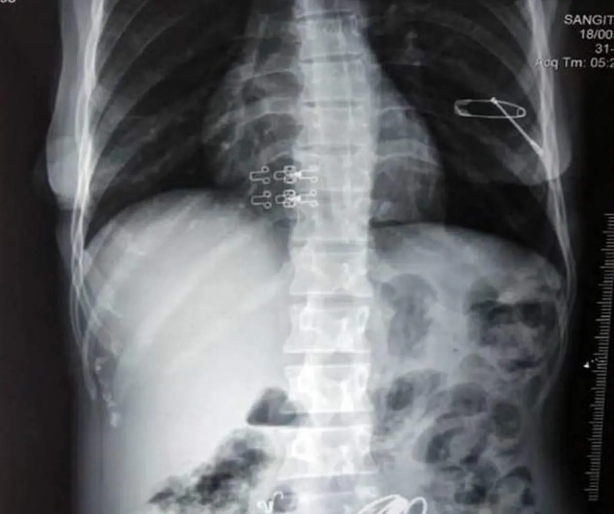 خروج بیش از ۱.۵ کیلو اشیای فلزی از معده یک زن!