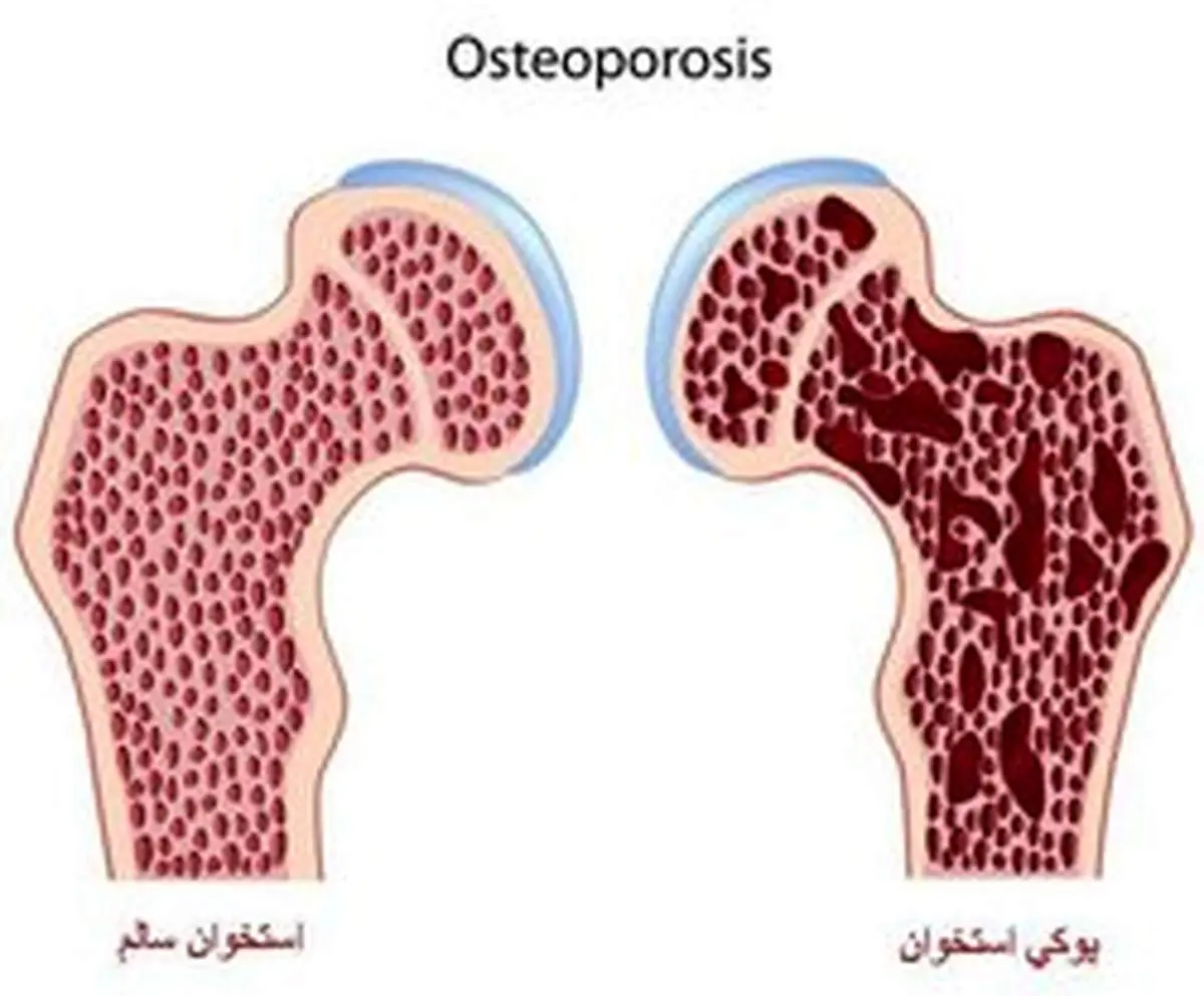 یک توصیه خوراکی برای پیشگیری از پوکی استخوان