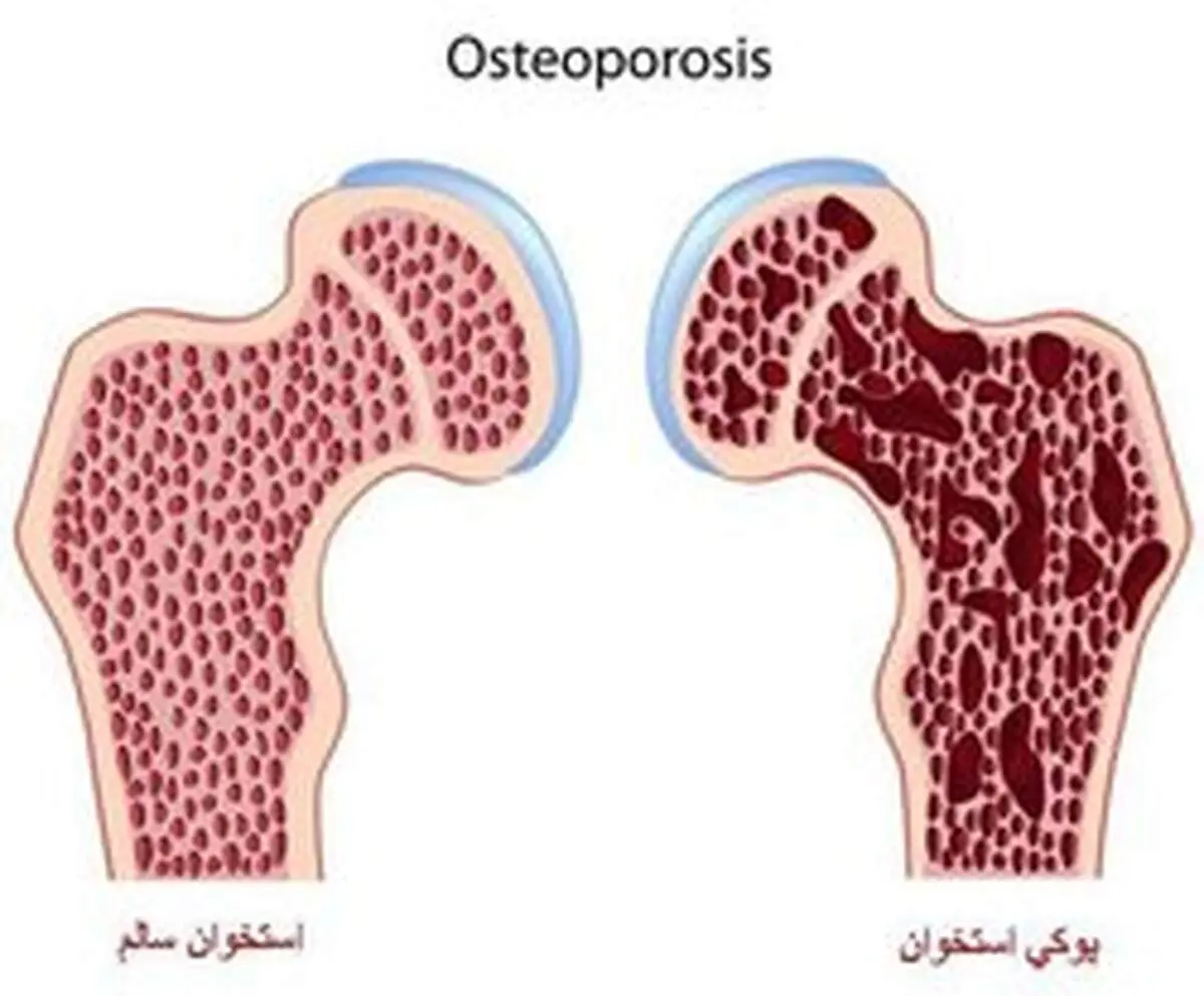 یک توصیه خوراکی برای پیشگیری از پوکی استخوان