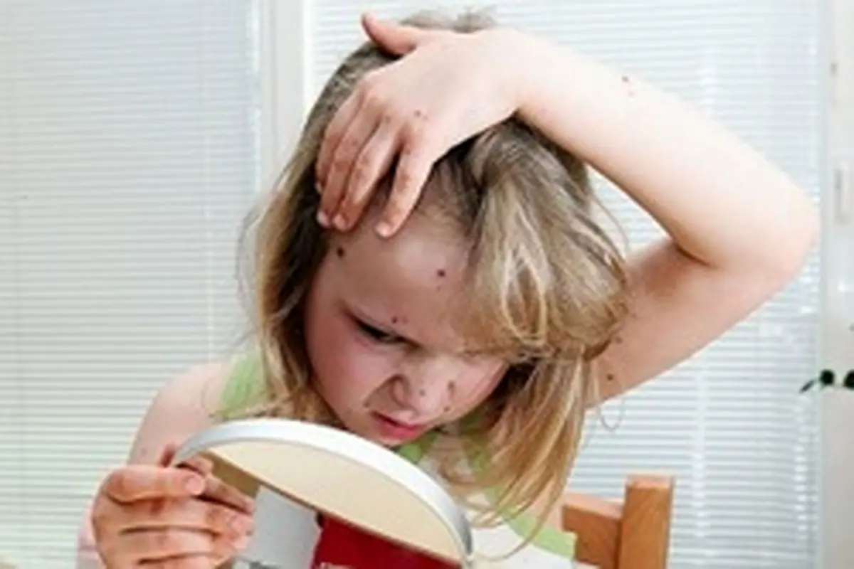 آبله مرغان و سوزاک در چه فصلی شیوع پیدا میکنند؟
