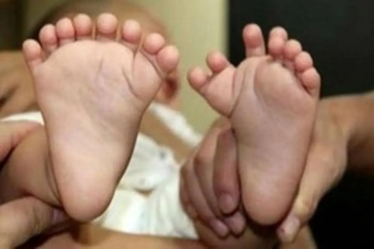 نوزادی با ۳۱ انگشت متولد شد +تصاویر