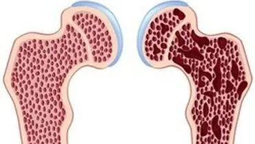 دیابت و فشار خون علت اصلی بیماری‌های کلیوی