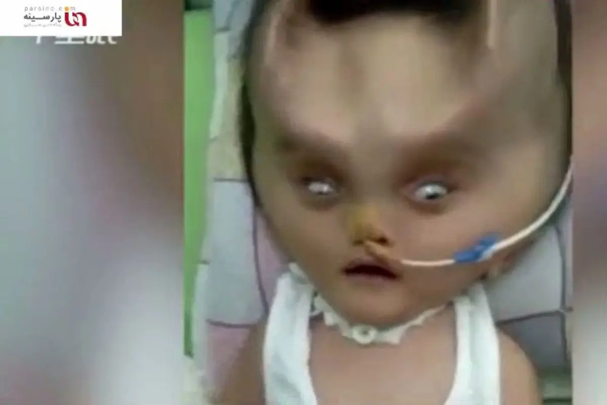 ویدیو| تولد نوزادی عجیب در فیلیپین