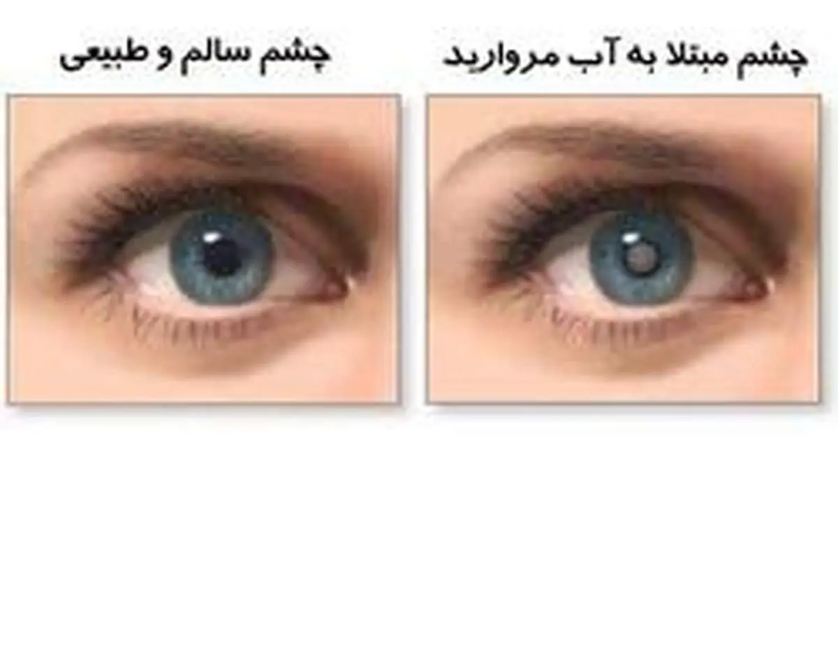 ۳ راهکار برای پیشگیری از ابتلا به آب مروارید