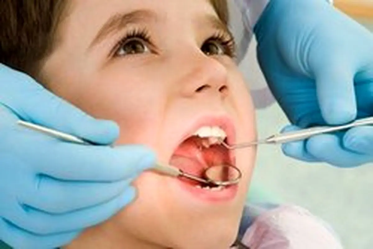 علت افزایش پوسیدگی‌ دندان ایرانی ها
