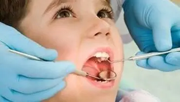 علت افزایش پوسیدگی‌ دندان ایرانی ها