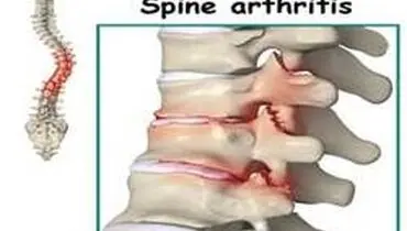 درباره روماتیسم ستون فقرات بیشتر بدانید