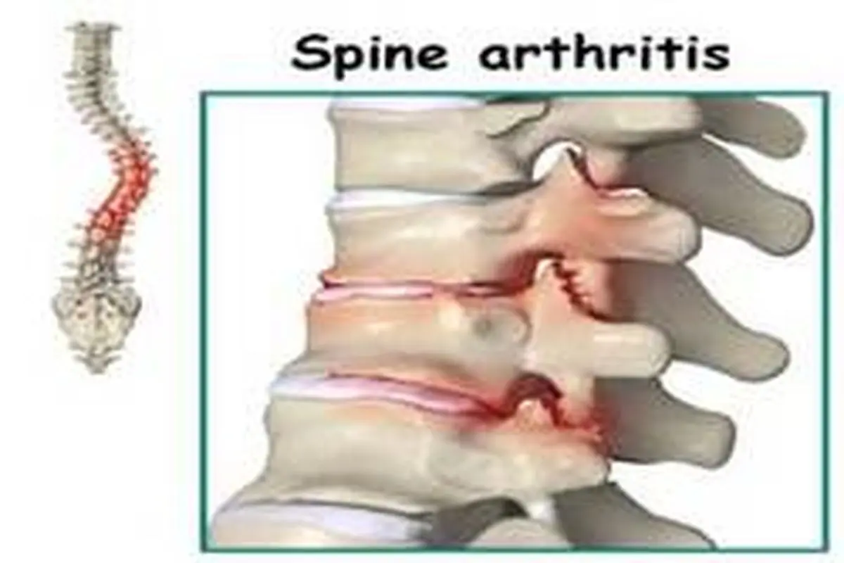 درباره روماتیسم ستون فقرات بیشتر بدانید