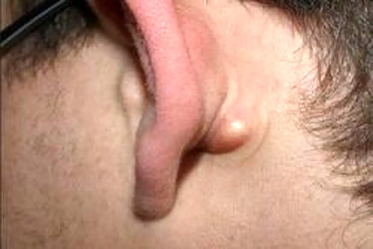 علت برآمدگى‌های پشت گوش چیست