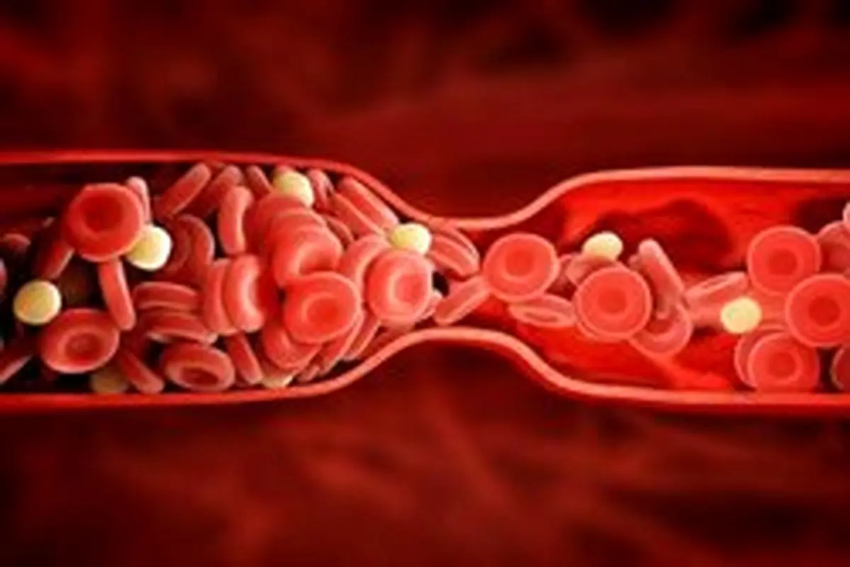 فاکتورهای پرخطر لخته شدن خون کدامند؟