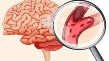 چگونه از عوارض سکته مغزی پیشگیری کنیم