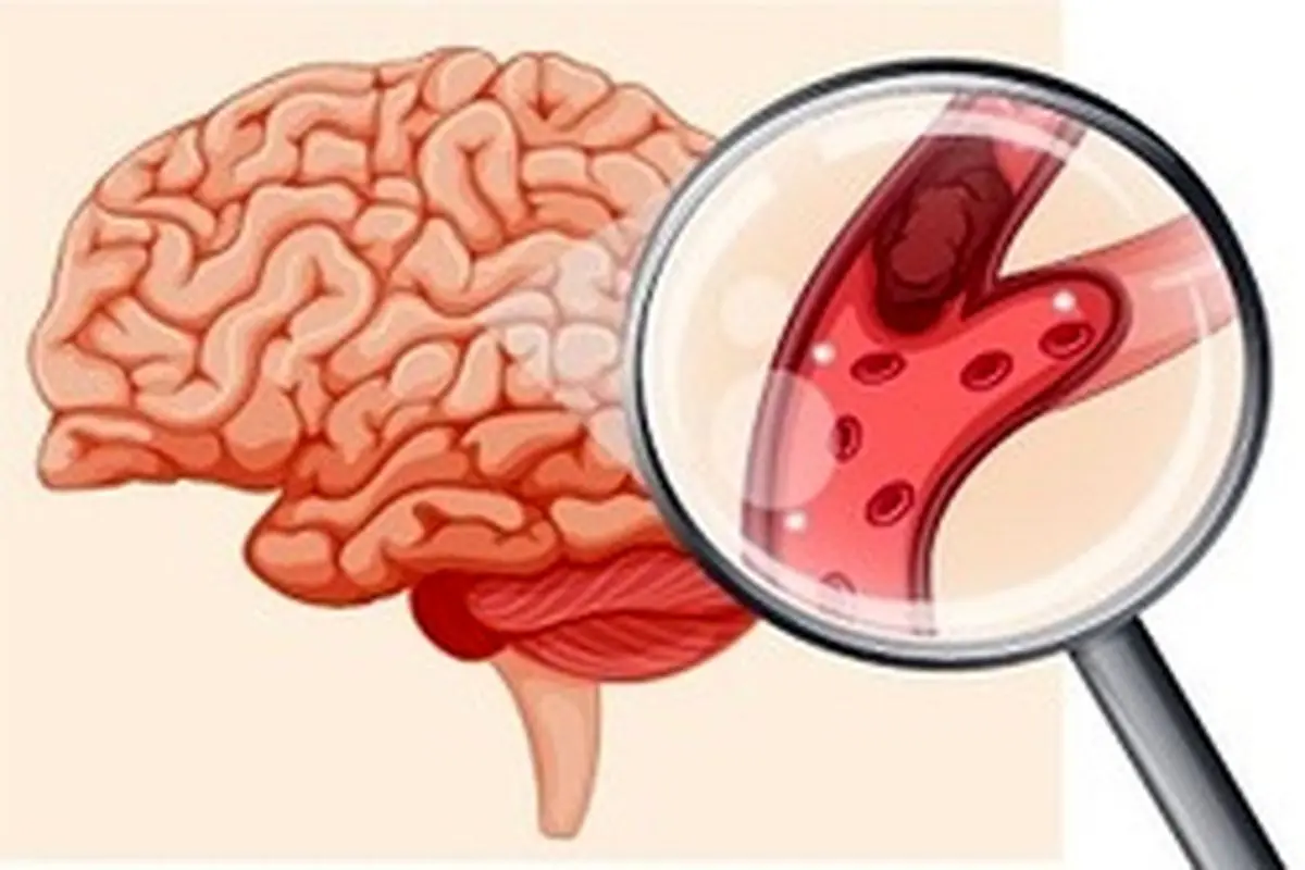 چگونه از عوارض سکته مغزی پیشگیری کنیم