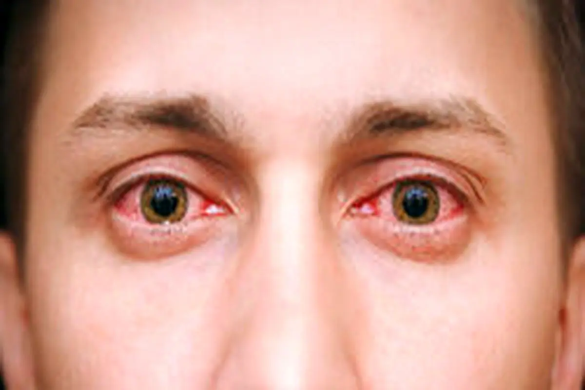 حفظ سلامت چشم‌ها در فصل سرما