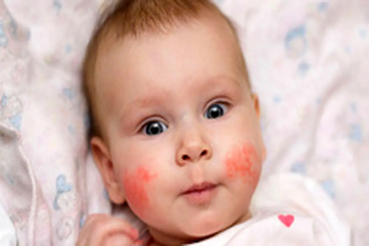 دلایل بروز زرد زخم در نوزادان