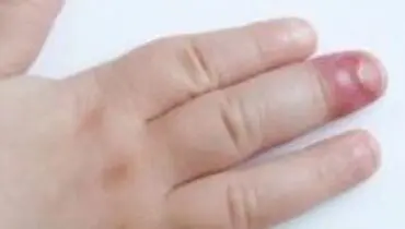 علت عفونت ناخن چیست