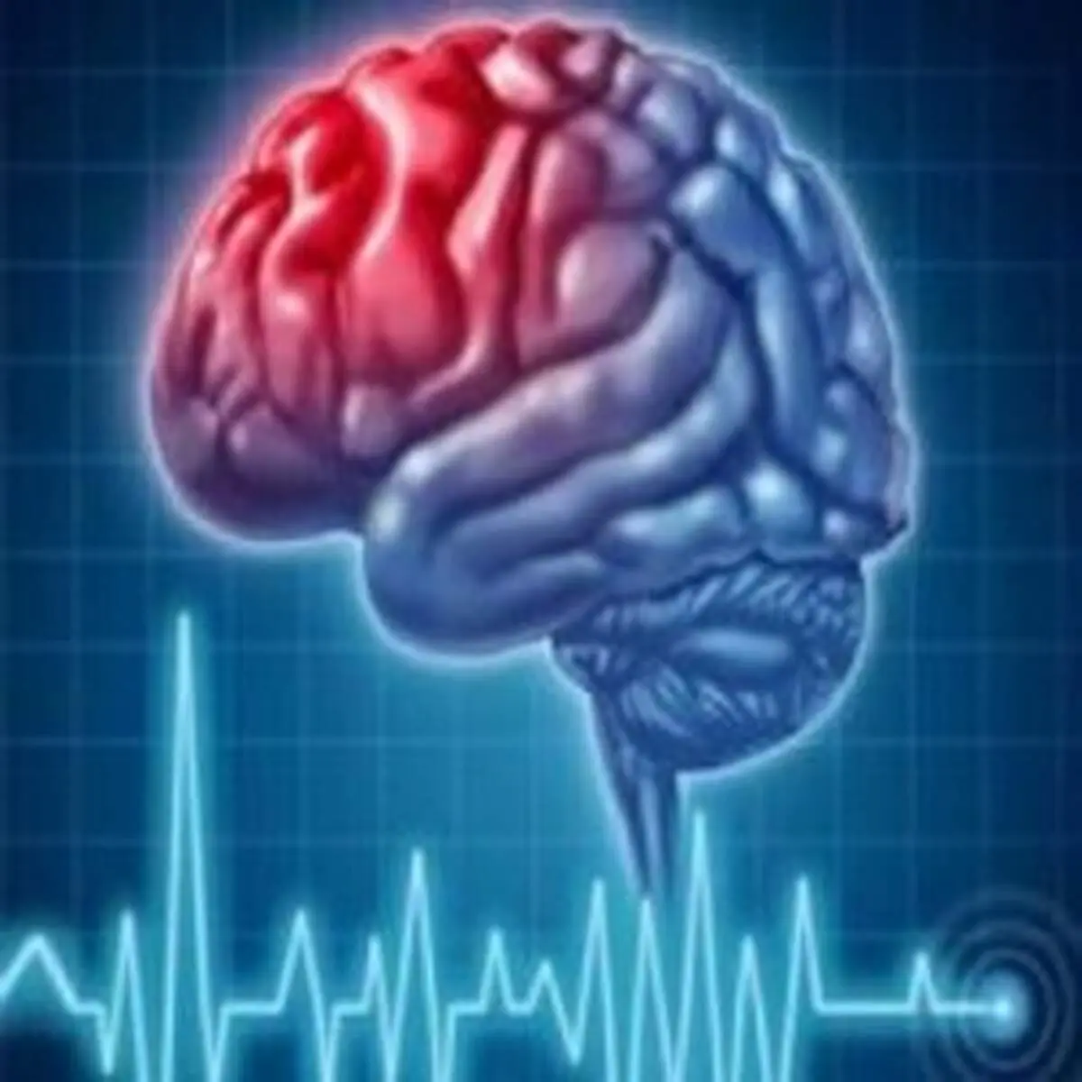 قلب چگونه موجب سکته مغزی می شود؟