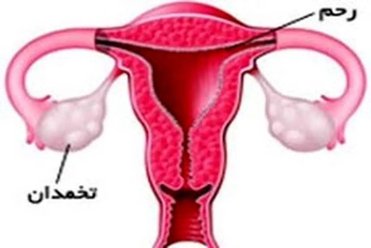 علت کم کاری تخمدان چیست؟