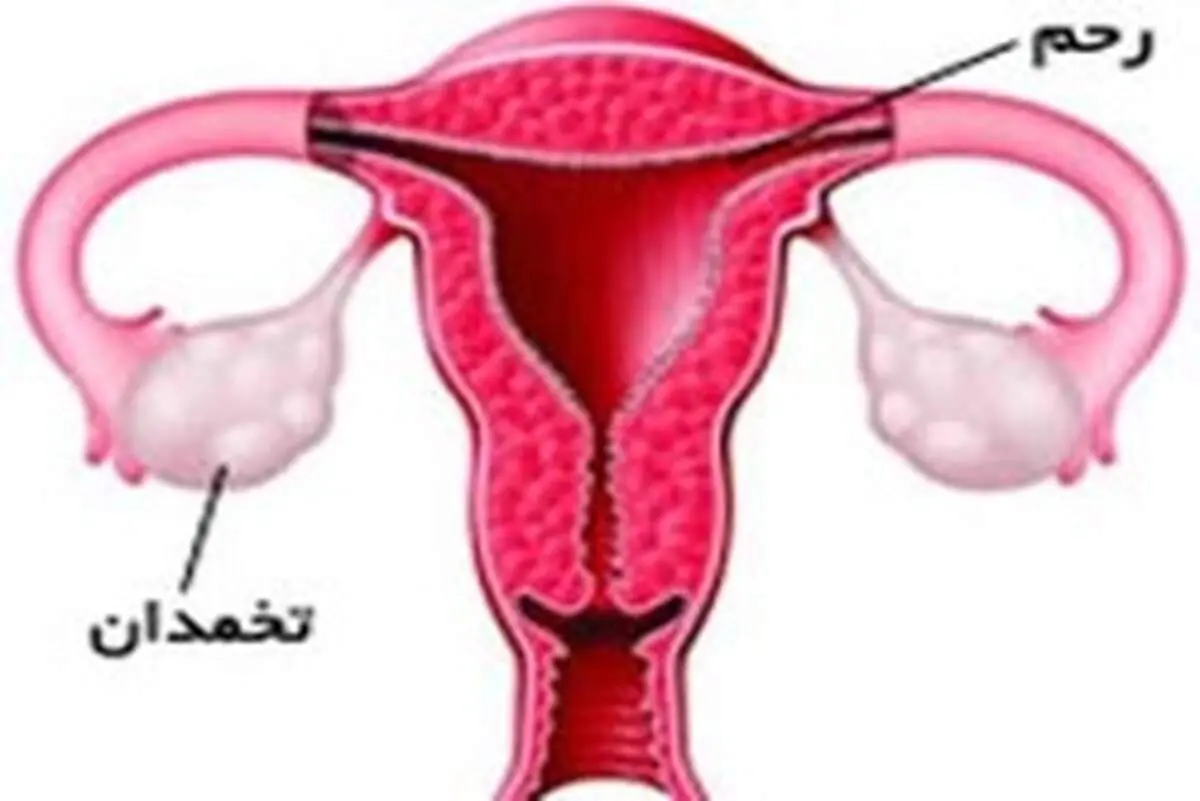 علت کم کاری تخمدان چیست؟