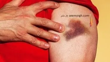 کبودی بدن بدون دلیل: بیان ۶ دلیل جالب