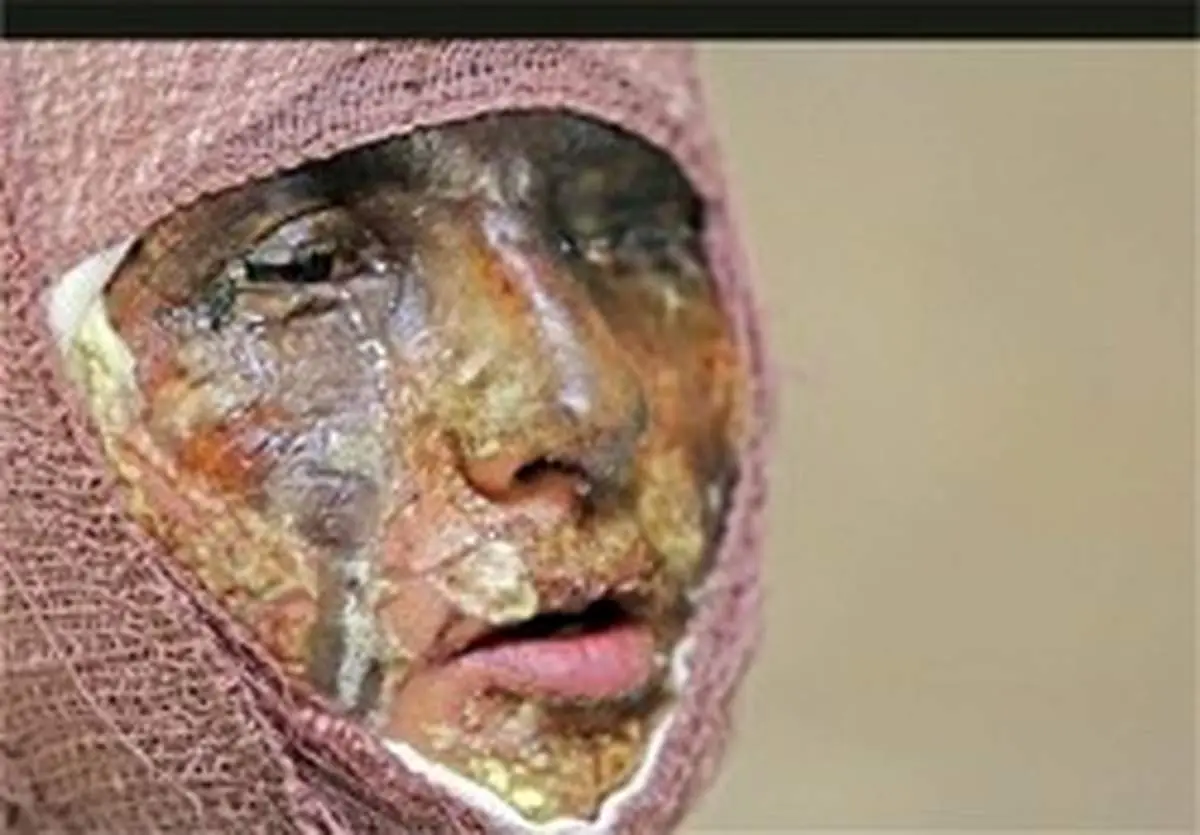 جزئیات حادثه اسیدپاشی در شاهینشهر