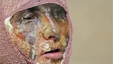 جزئیات حادثه اسیدپاشی در شاهین‌شهر