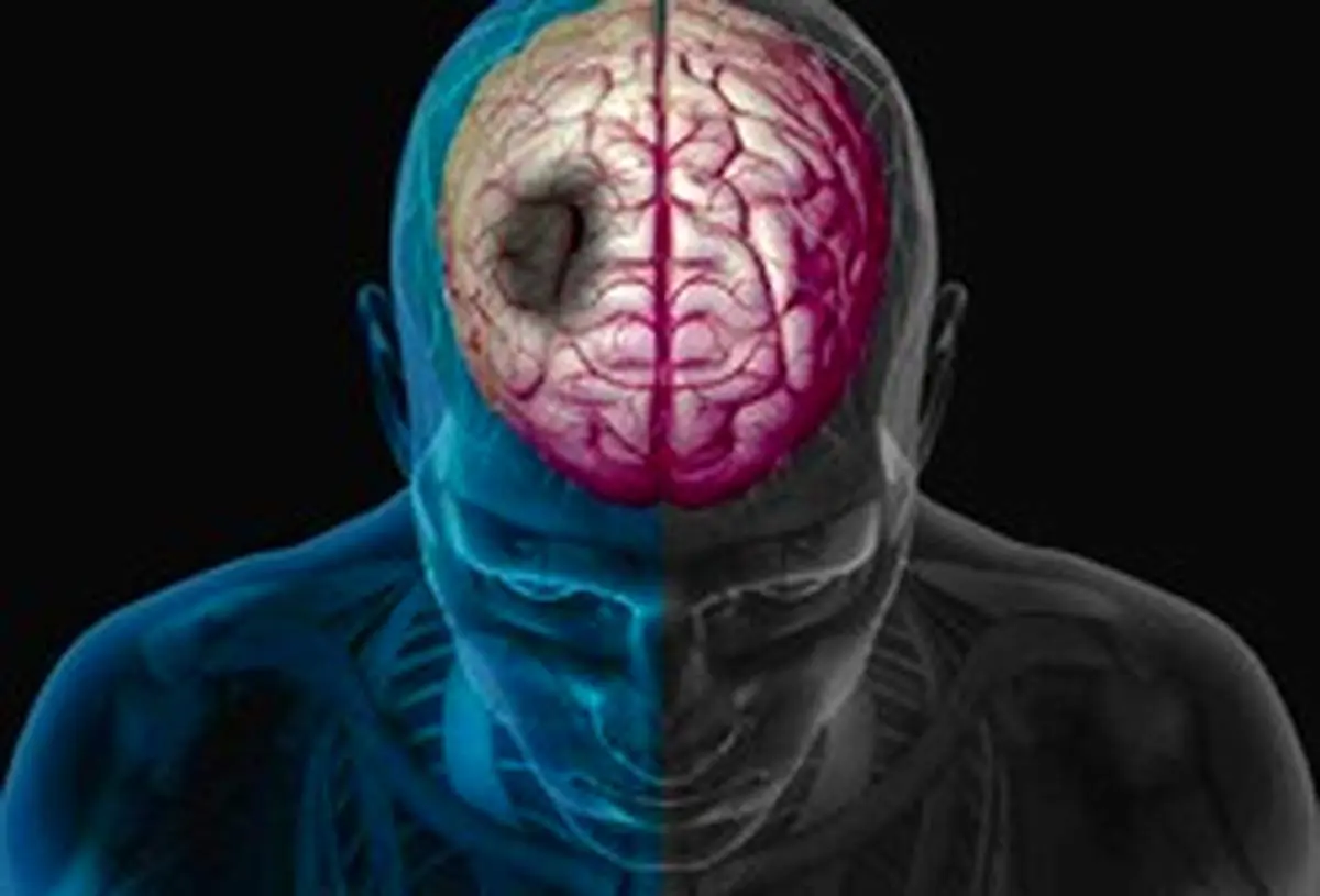 بیماریهایی که سکته مغزی را به جانتان میاندازند