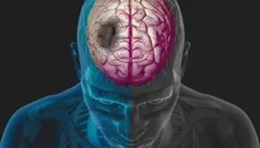 بیماری‌هایی که سکته مغزی را به جانتان می‌اندازند