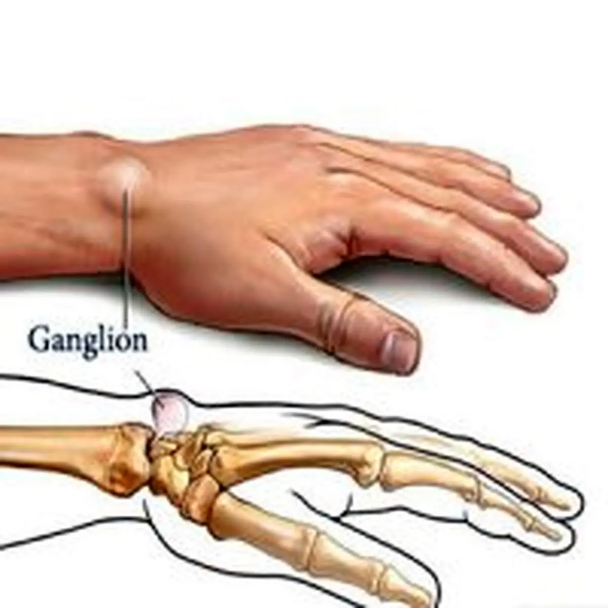 علل بروز کیست مچ دست و ترفند‌های سنتی برای درمان آن