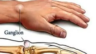 علل بروز کیست مچ دست و ترفند‌های سنتی برای درمان آن