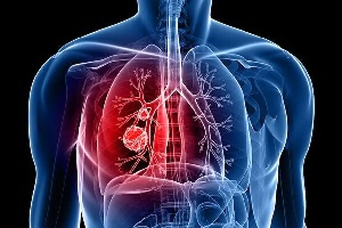 علت سرطان ریه و نشانه‌های آن