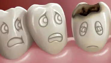 هر کودک ۱۲ ساله چند دندان خراب دارد؟