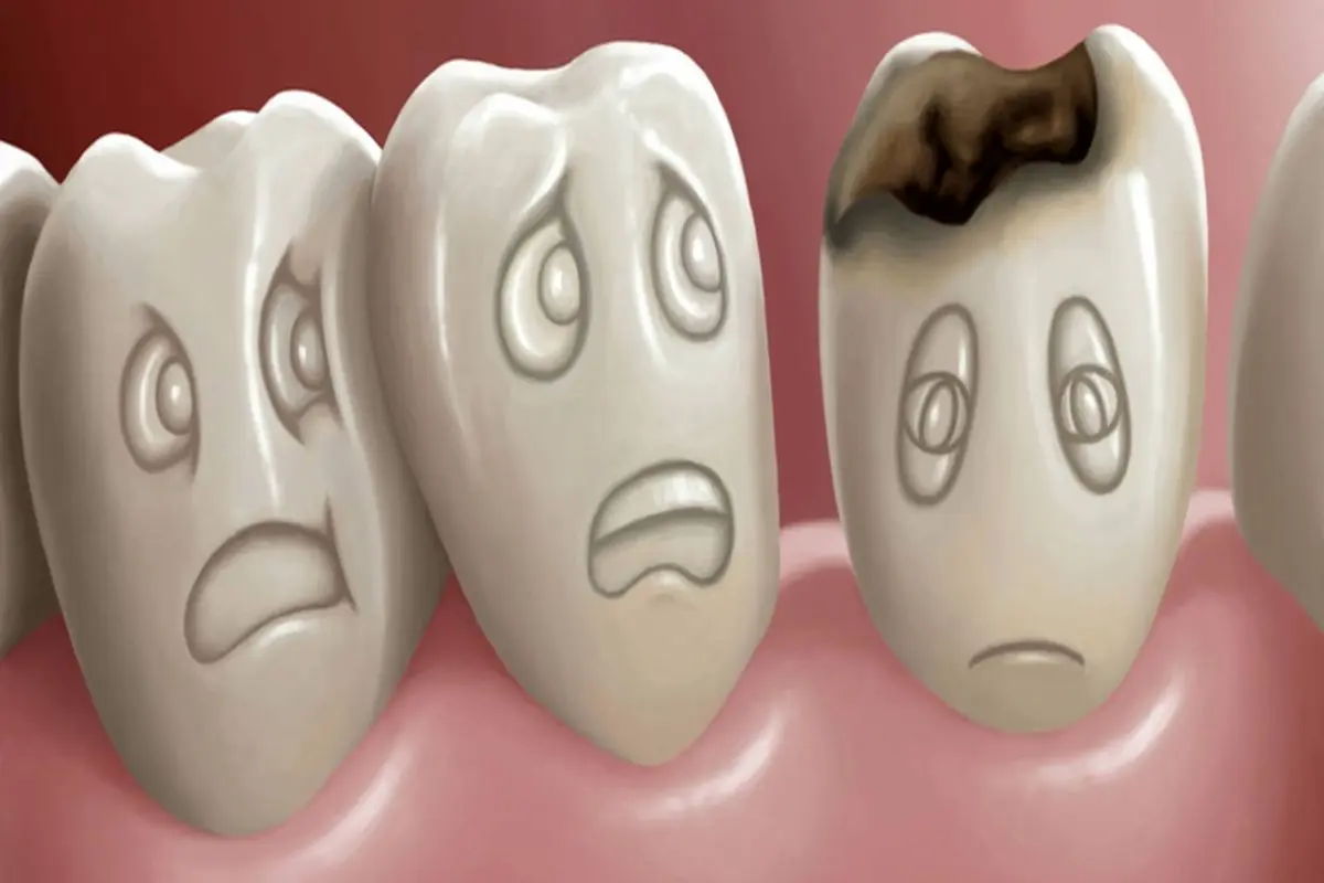 هر کودک ۱۲ ساله چند دندان خراب دارد؟
