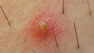 چند راهکار خانگی برای برطرف کردن مو‌های زیر پوستی