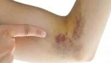 ۳ مکمل غذایی برای پیشگیری از کبودی پوست