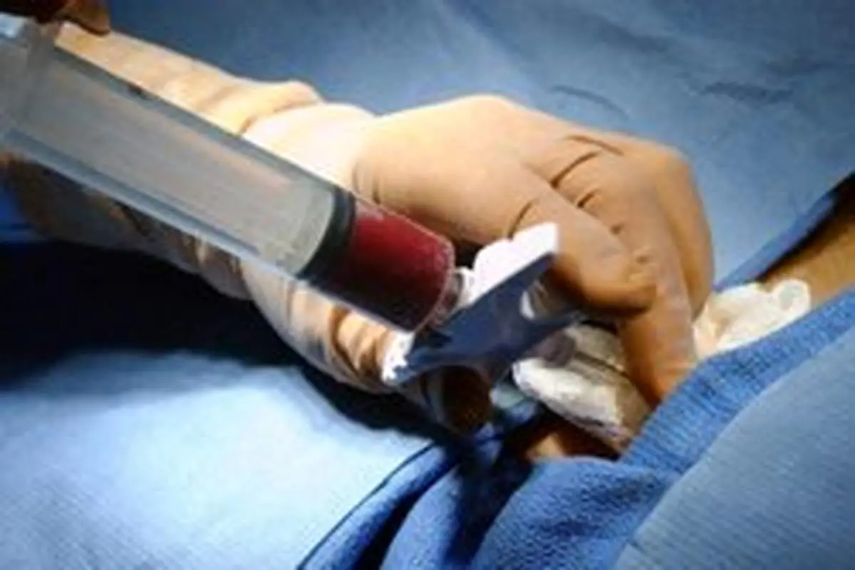 انجام موفقیت آمیز اولین پیوند مغز استخوان در بیمار مبتلا به HIV
