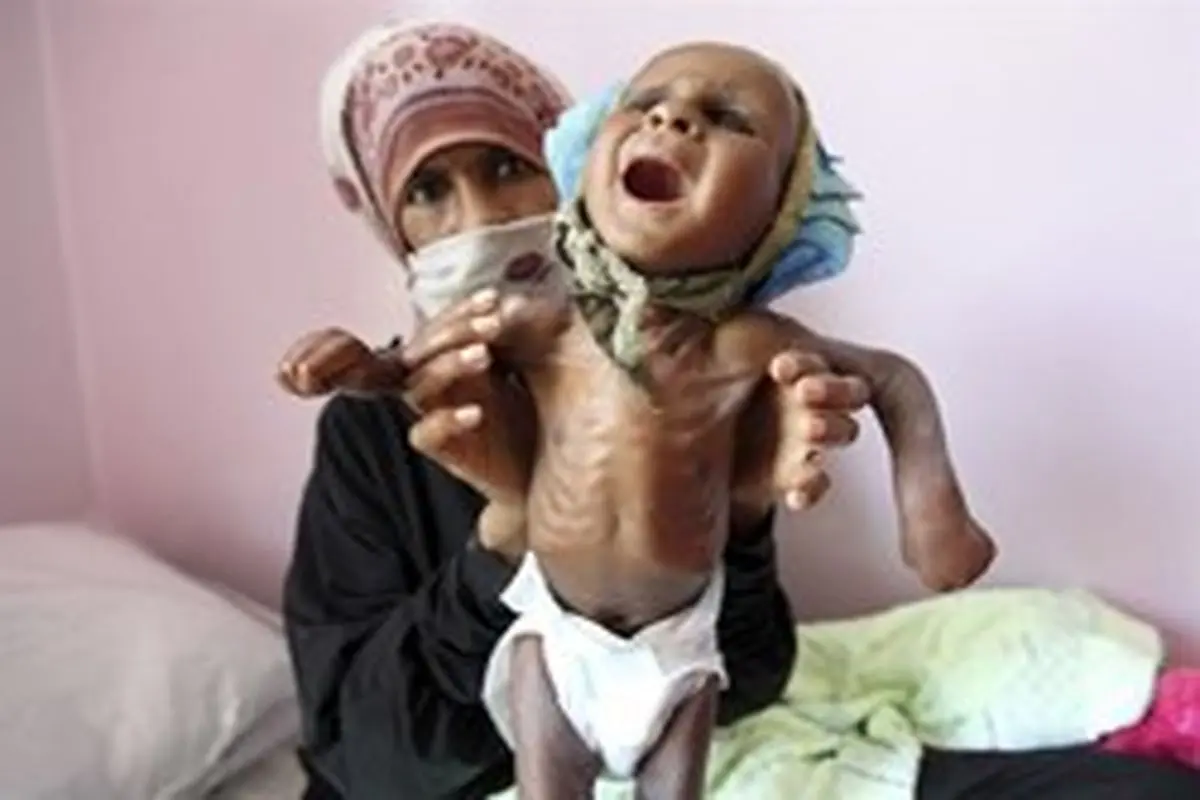 سوء تغذیه بیش از ۲ میلیون کودک یمنی