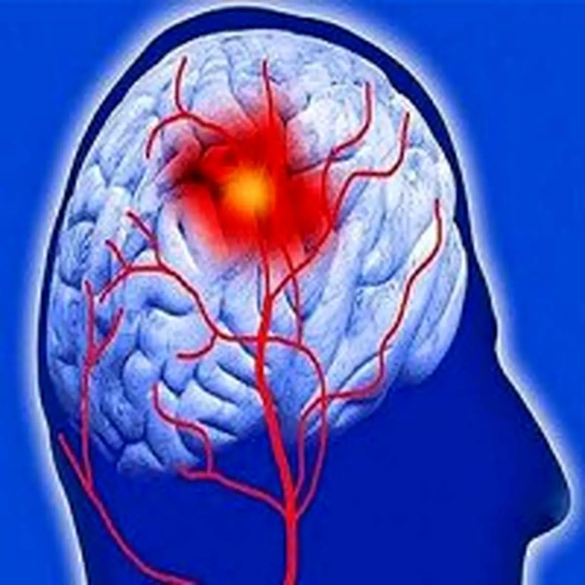 راههای پیشگیری از سکته مغزی را بدانیم