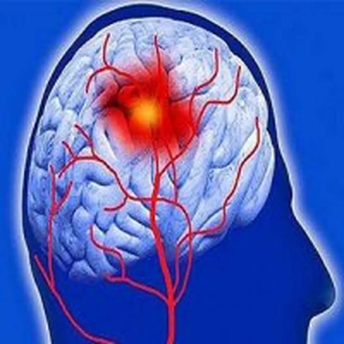 راه‌های پیشگیری از سکته مغزی را بدانیم