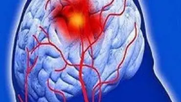 راه‌های پیشگیری از سکته مغزی را بدانیم