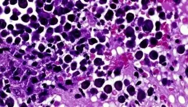 کشف تازه برای مقابله با مقاوم شدن سلول‌های سرطانی