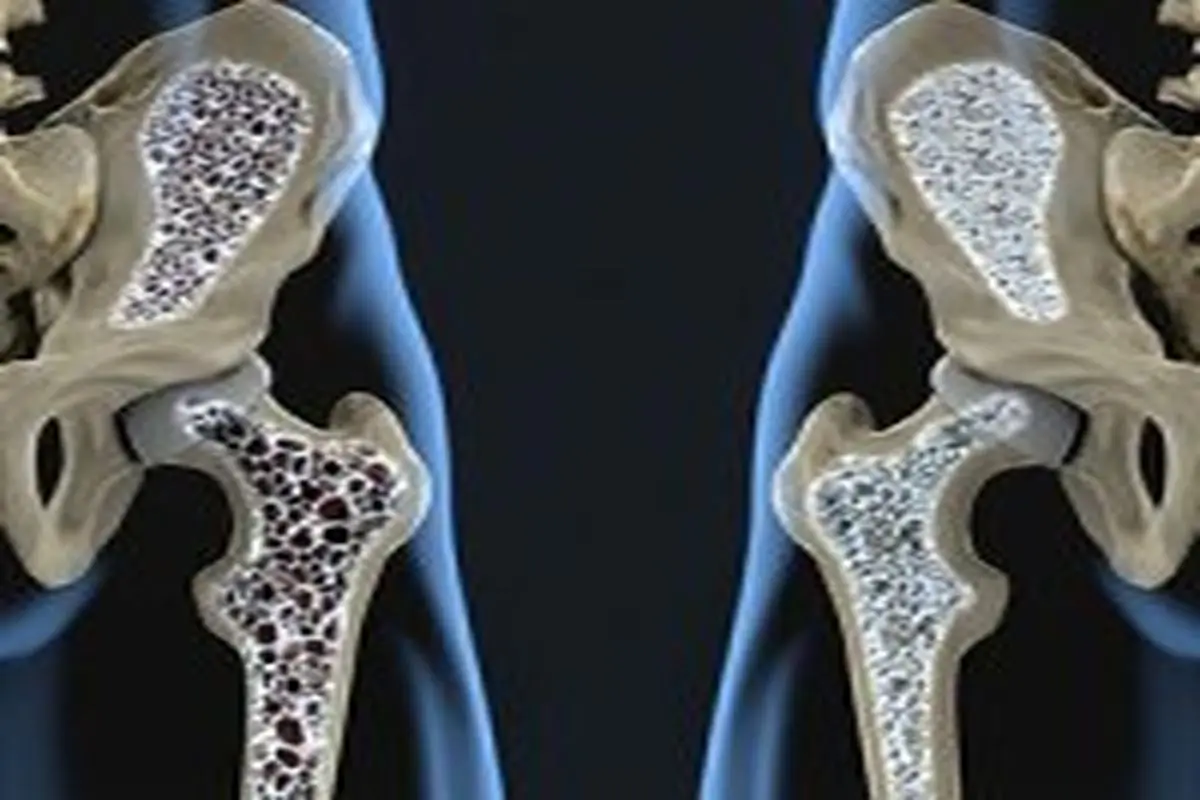 خطر ابتلای مردان به پوکی استخوان بیشتر از حد انتظار