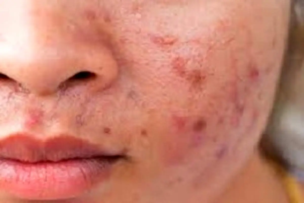 خوراکی‌های تشدید کننده آکنه