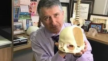 بازسازی جمجمه شکسته یک نوجوان با چاپگر سه بعدی