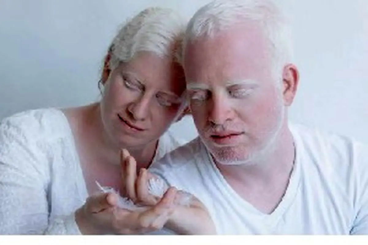 بیماری زالی یا آلبینیسم Albinisme چیست و چه مشکلاتی دارد؟