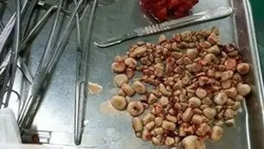 دفع فوری سنگ کلیه بدون دارو