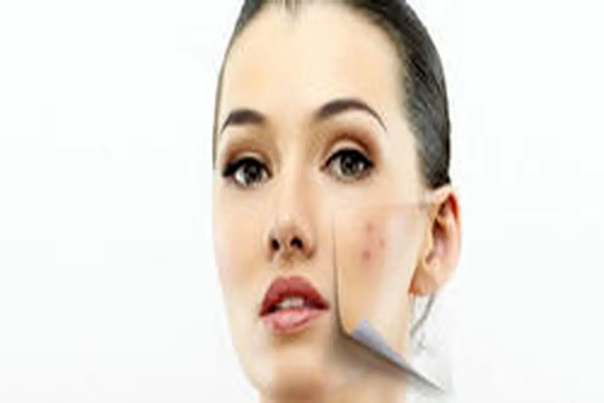 روشهای خانگی از بین بردن لک صورت